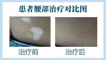 病因病理-白癜风患者应避免接触的物品